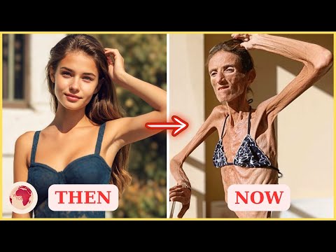 30 Celebrities Gone Too Soon from Anorexia | Then and Now 2025